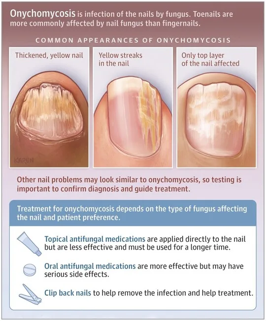 Clinical Manifestations Of Onychomycosis 1