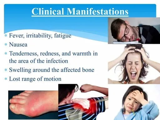 Clinical Manifestations Of Osteomyelitis