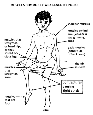 Clinical Manifestations Of Paralytic Polio