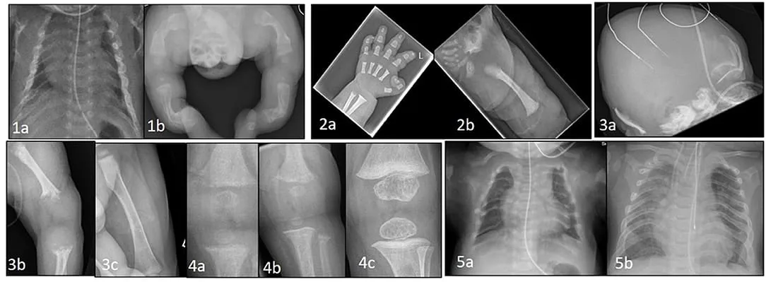 Clinical Manifestations Of Osteopenia Of Prematurity 1