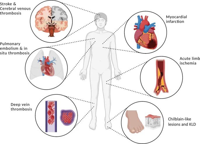Clinical Manifestations Of Thrombus 1