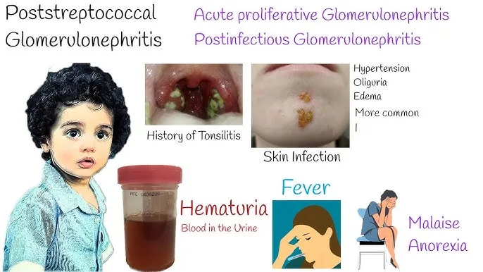 Clinical Presentation Of Glomerulonephritis