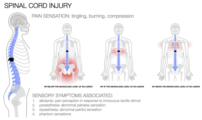 Clinical Presentation Of Spinal Cord Compression 1