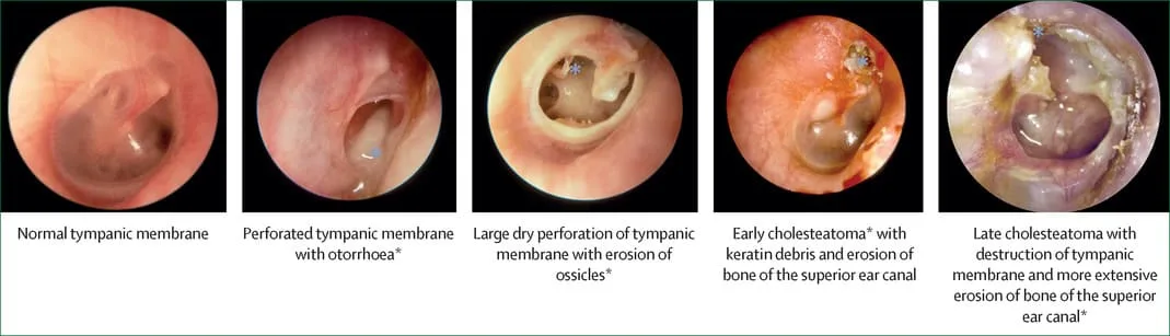 Clinical Presentation Of Otitis Media 1