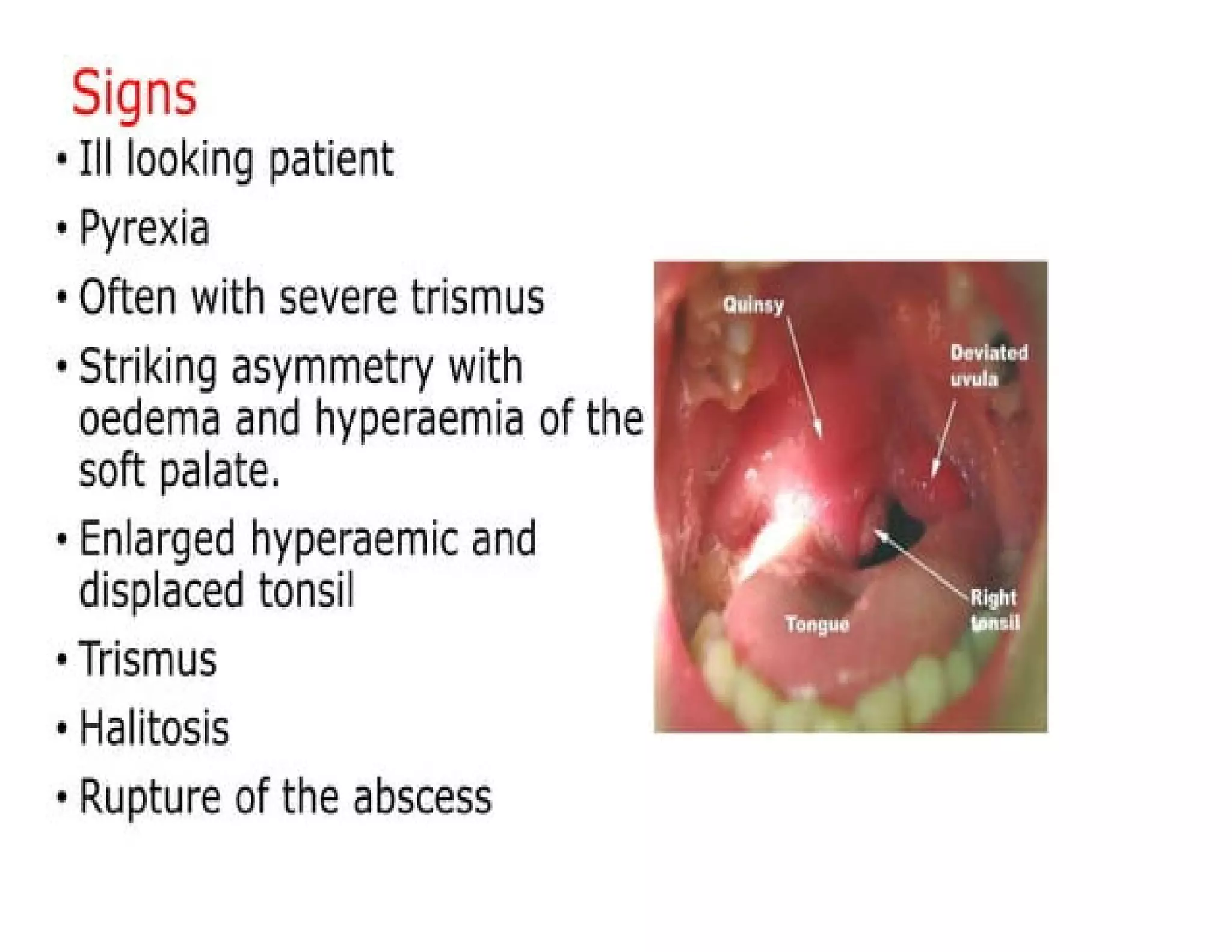 Clinical Presentation Of Peritonsillar Abscess