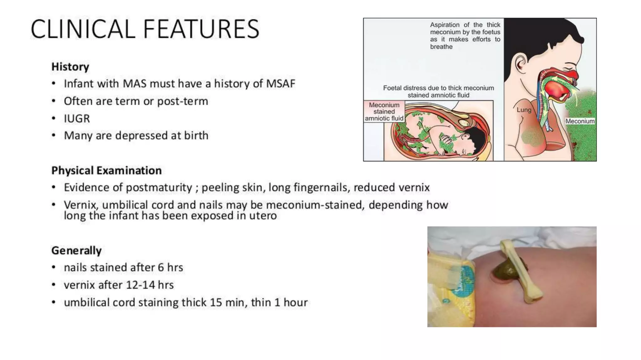 Clinical Presentationof Meconium Aspiration