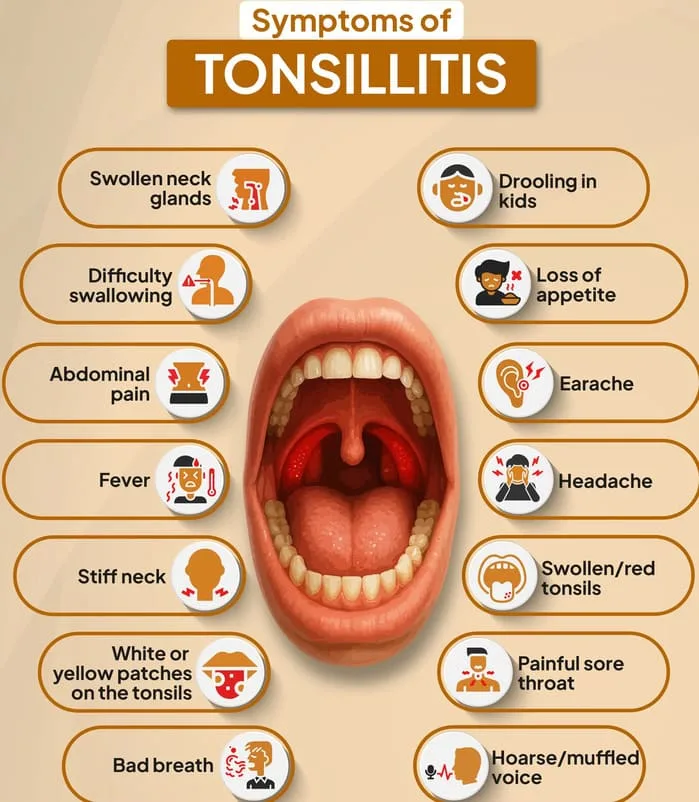 Clinical Presentations Of Tonsillitis 1