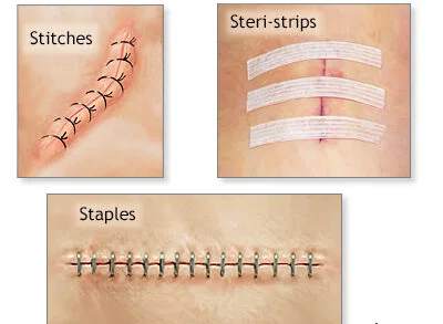 Clips Metal Sutures In Wound Closure E1742278573317