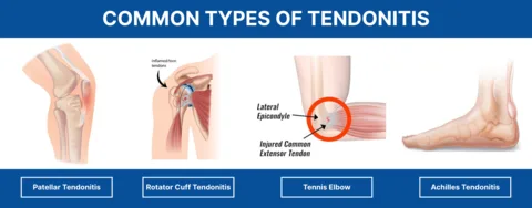 Common Types Of Tendonitis 2