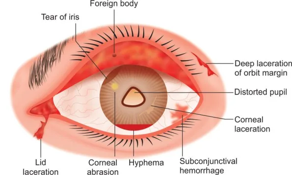 Common Injuries To The Eye 1