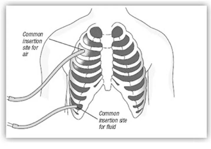 Common Insertion Site Of Chest Tube For Air And Fluid