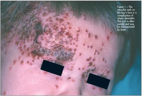 Complications Of Atopic Dermatitis