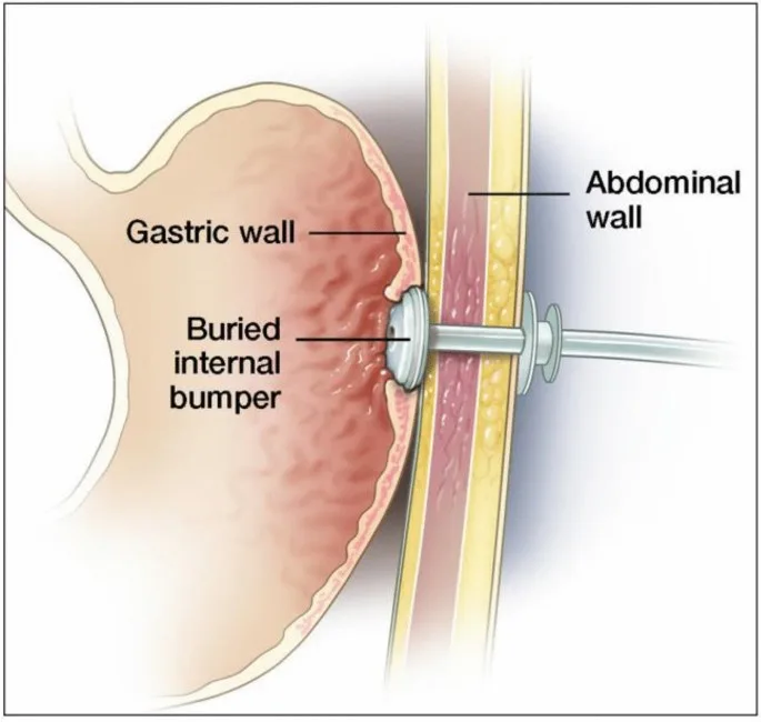 Complications Of Gastrostomy Feeding