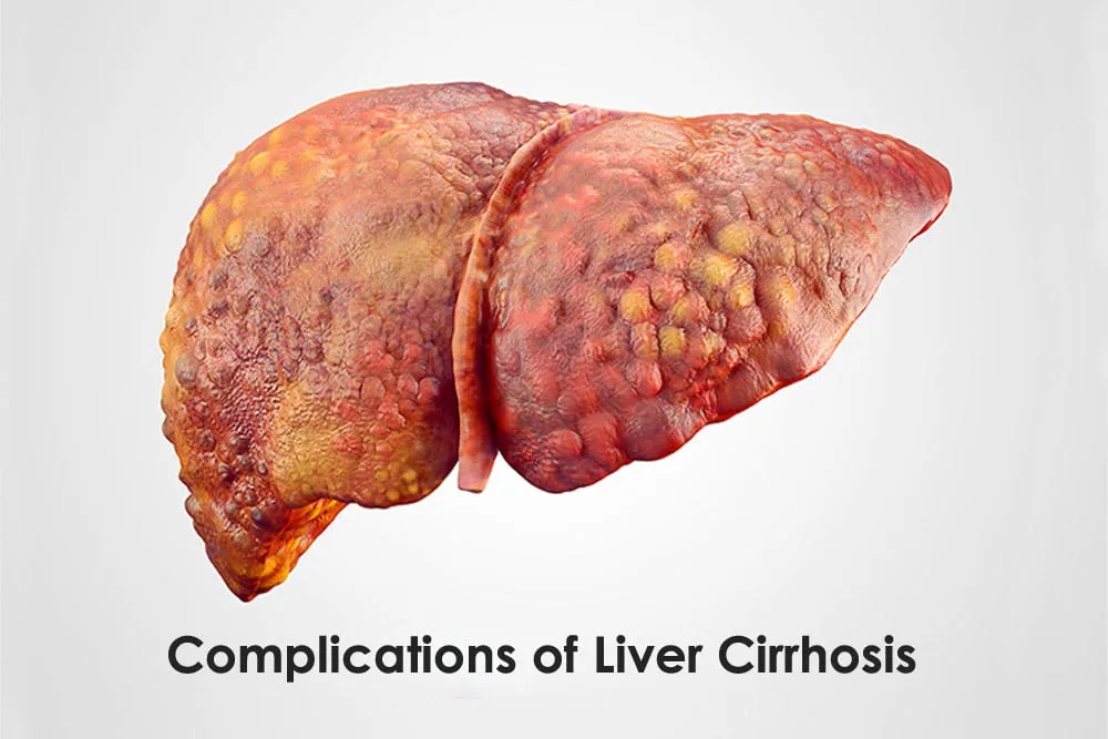 Complications Of Liver Cirrhosis