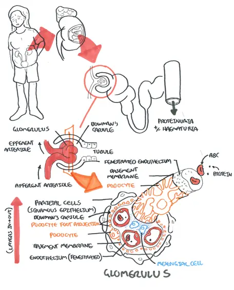 Complications Of Nephritic Syndrome
