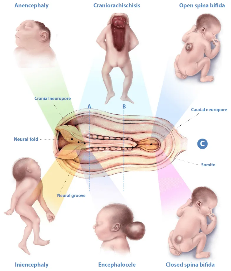 Congenital Anomalies Of The CNS