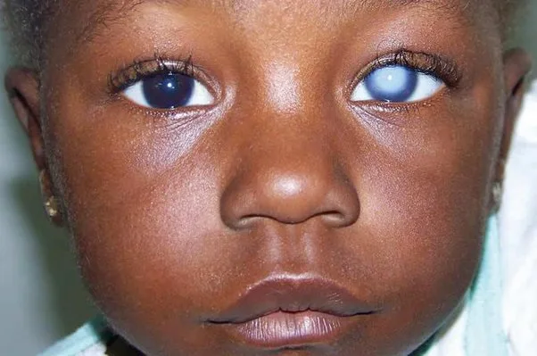 Congenital Cataract