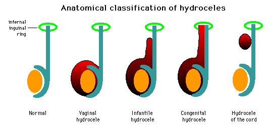 Congenital Hydrocele