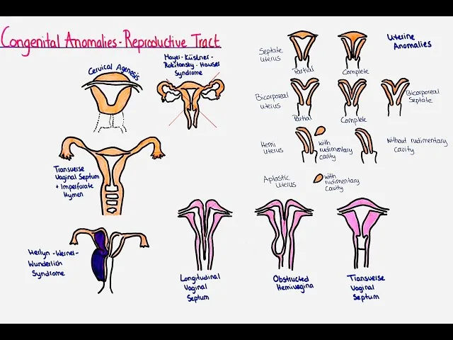 Congenital Abnormalities Of The Reproductive Organs