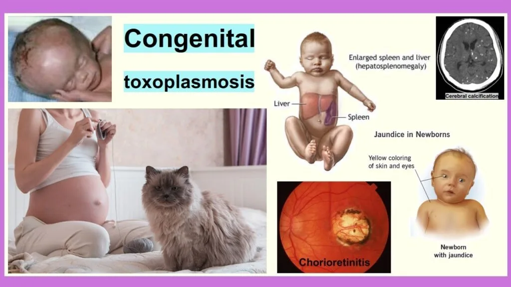 Congenital Toxoplasmosis