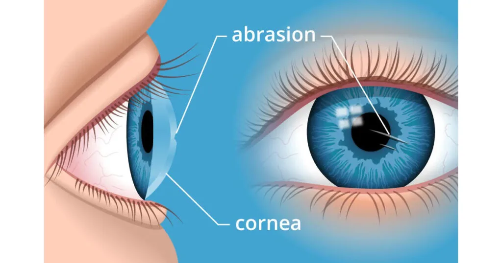 Corneal Abrasion 1024x538