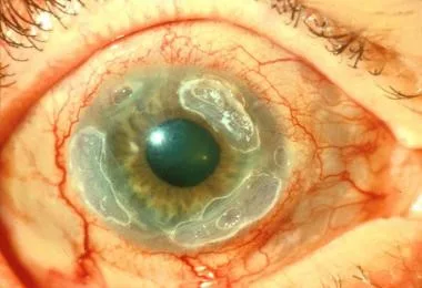 Corneal Ulcers