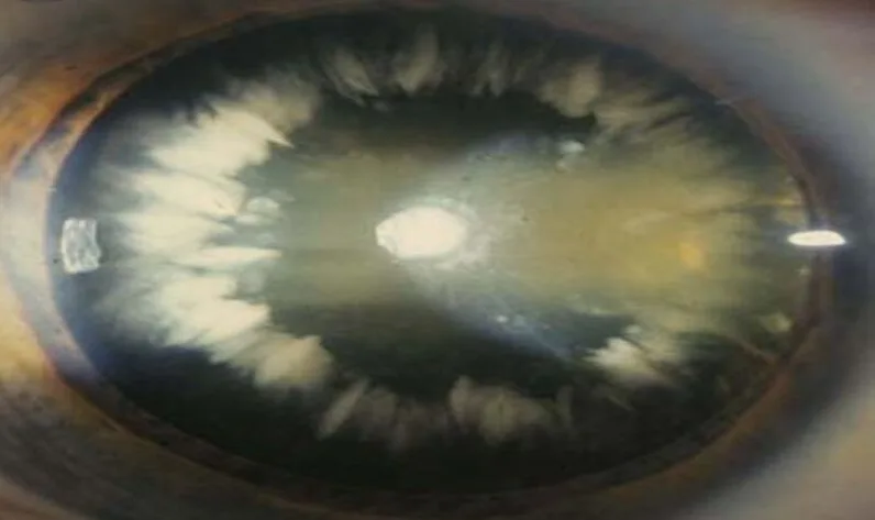 Coronary Cataract E1708442311901