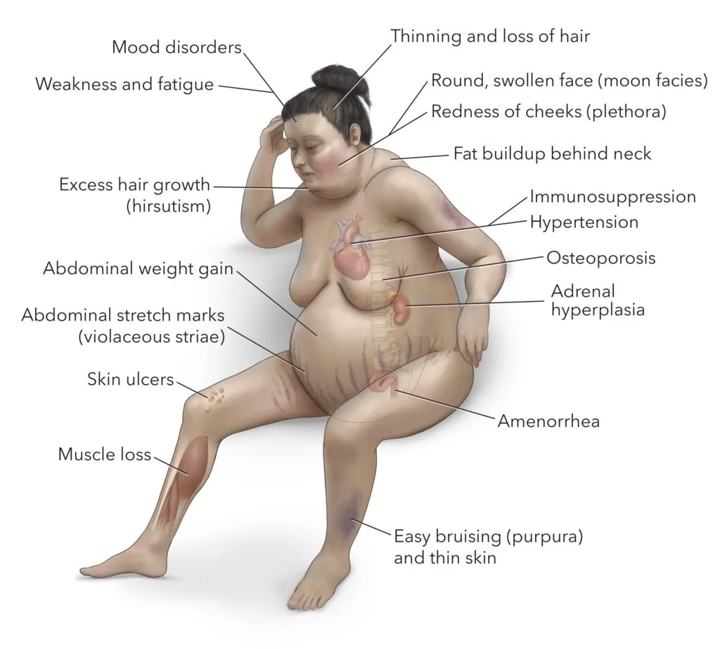 Cushings Syndrome