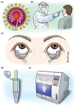 DIAGNOSTIC Conjuctivitis