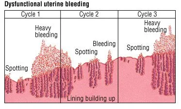 DYSFUNCTIONAL UTERINE BLEEDING