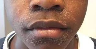 Dermatitis