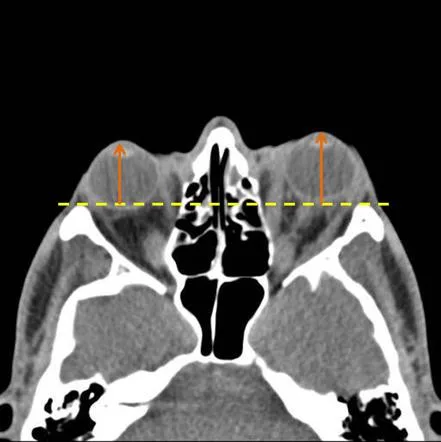 Diagnosing Proptosis