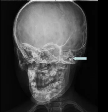 Diagnosis And Investigations Of Foreign Bodies In The Ear
