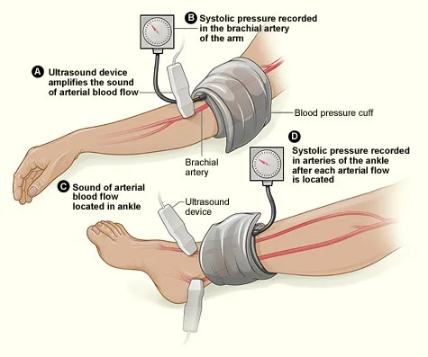 Diagnosis Of Atherosclerosis
