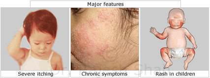 Diagnosis Of Eczema