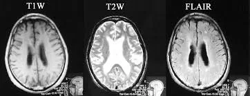 Diagnosis Of GPI