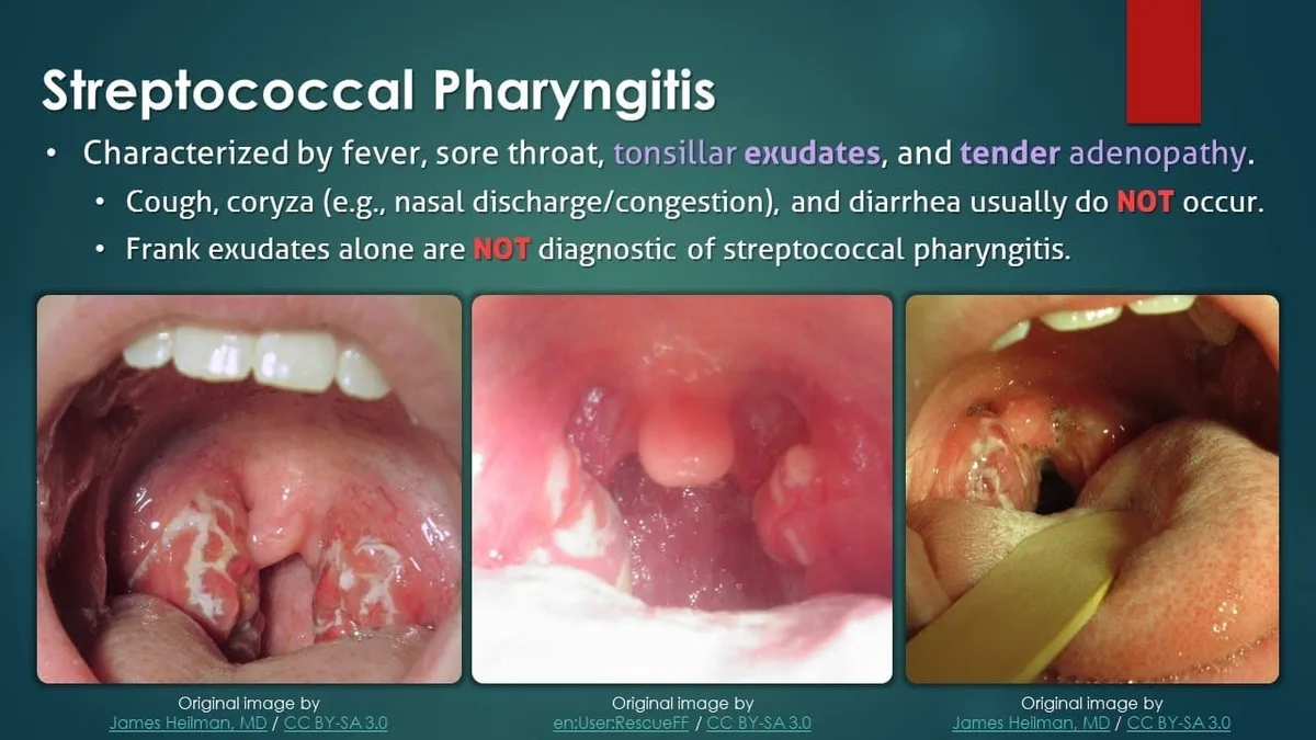 Diagnosis Pharyngitis 1