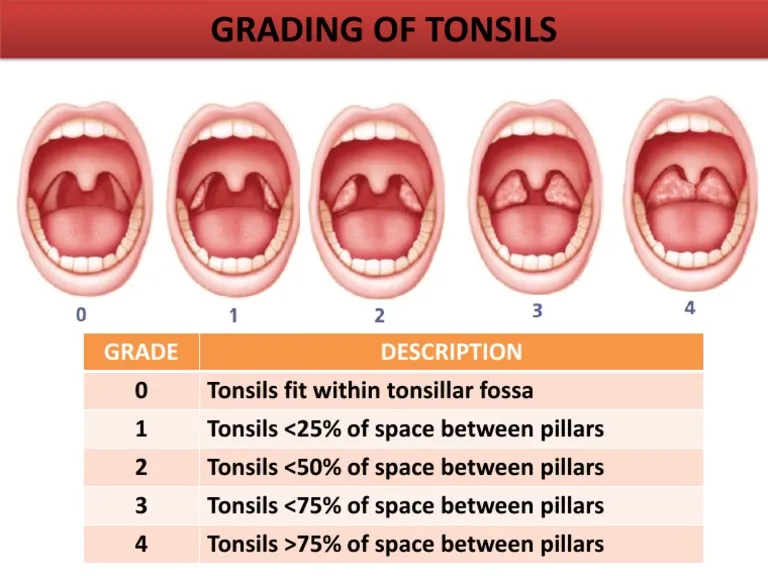 Diagnostic Approaches Of Tonsillitis