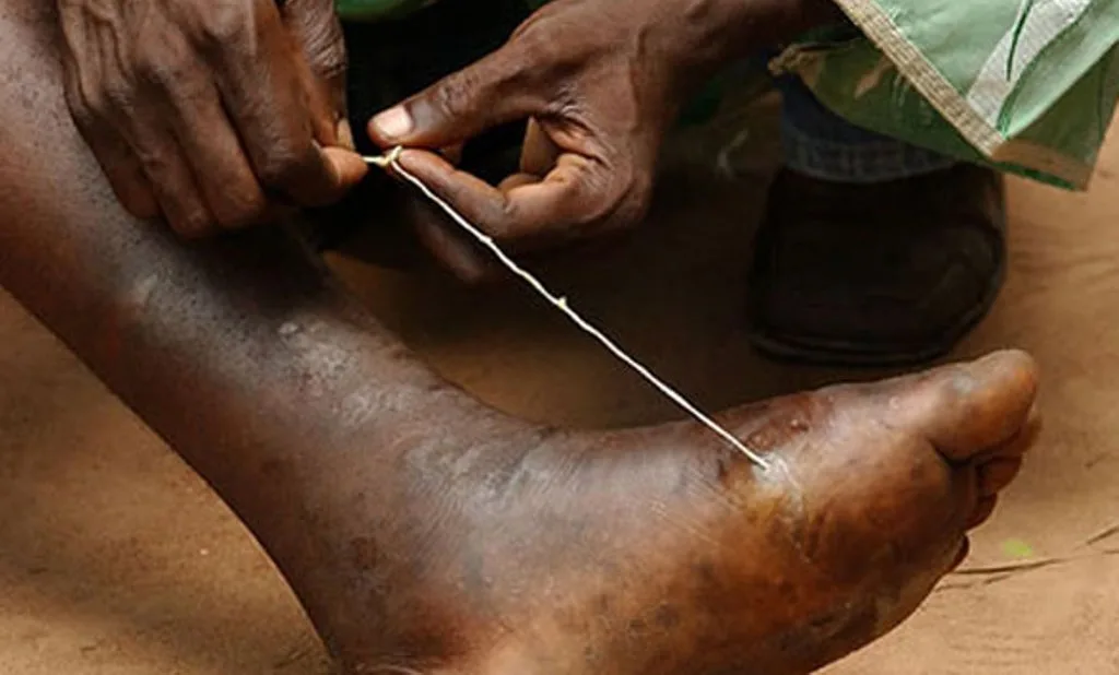 Dracunculosis Guinea Worm