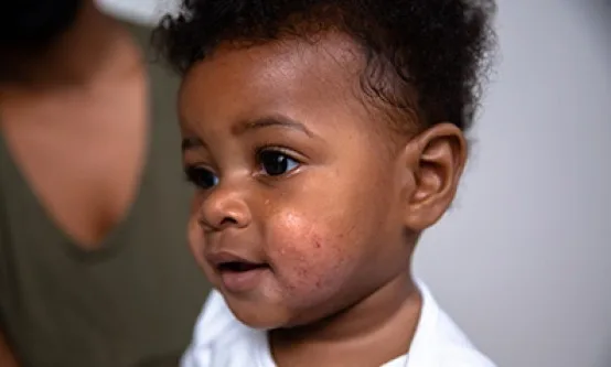 ECZEMA