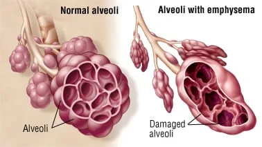 EMPHYSEMA PULMONARY EMPHYSEMA