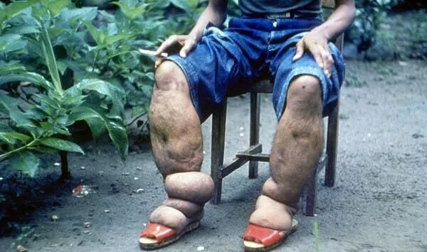 Elephantiasis Bancroftian Filariasis 1 1 E1736827844737