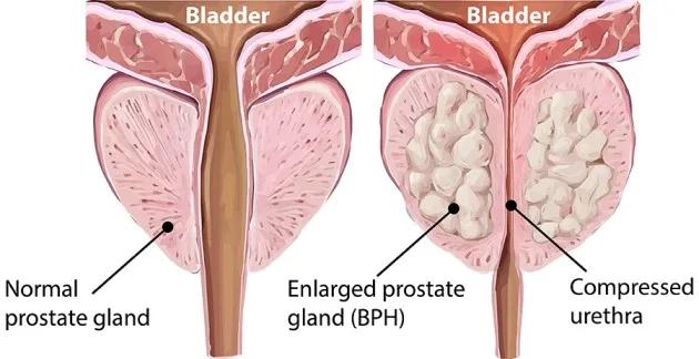 Enlarged Prostate Gland BPH
