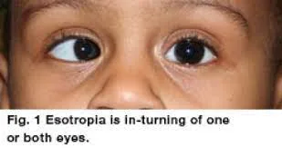 Esotropia