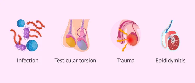 Etiology Causes Of A Hydrocele