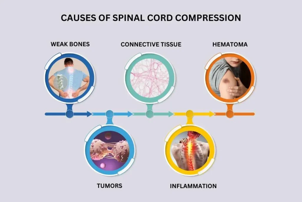 Etiology Of Spinal Cord Compression