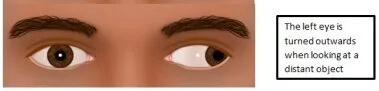 Exotropia E1708525212546