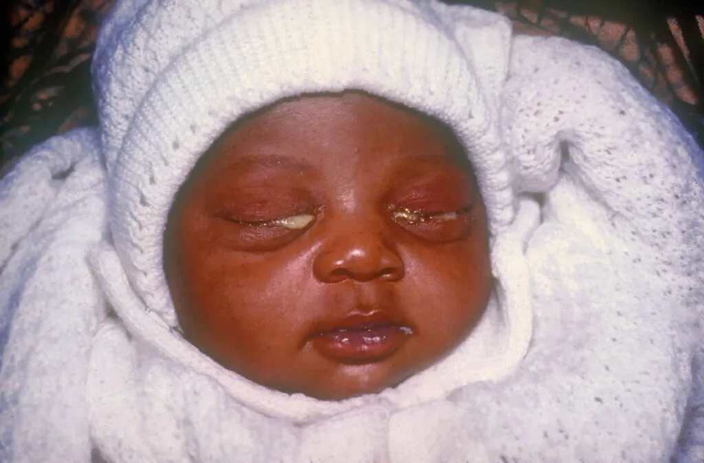Eye Infections In Children 1