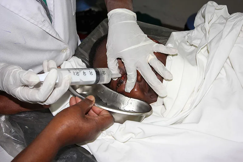Eye Irrigation Nurses Revision