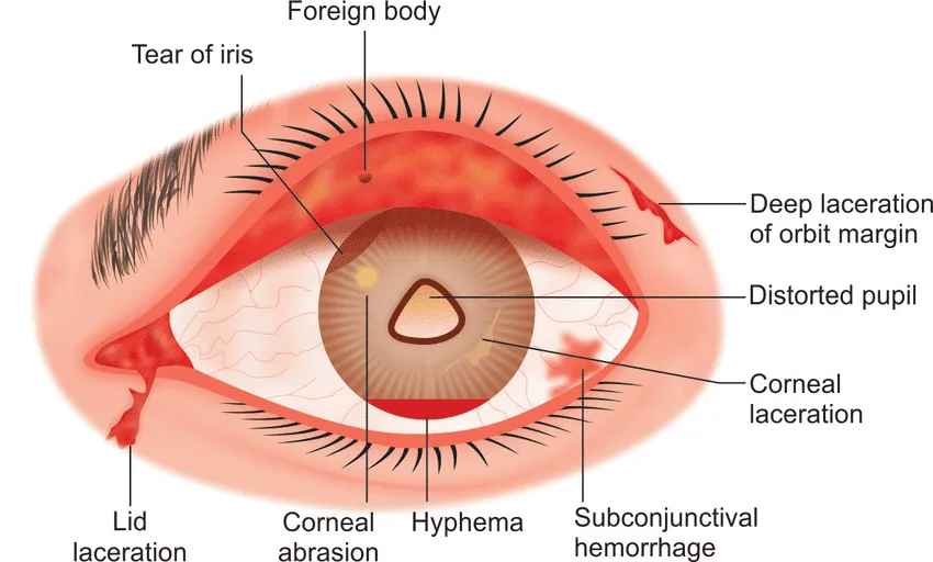 Eye Injury Symptoms 1